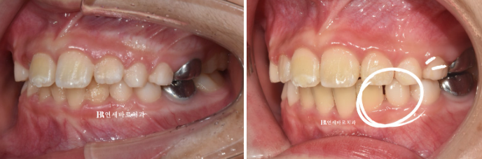 A Real Case of Preventing Crowded Teeth with Invisalign First for a Child in Gangnam image 5