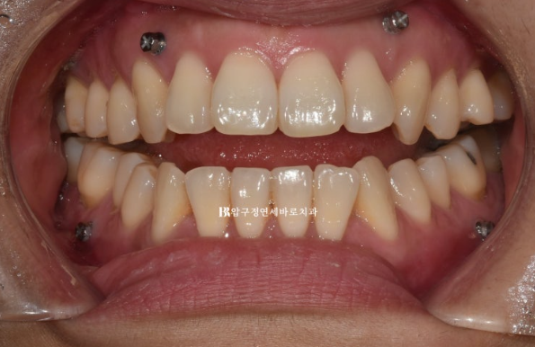 양악수술 선수술 교정 후기 인비절라인 교정 관련 이미지 3