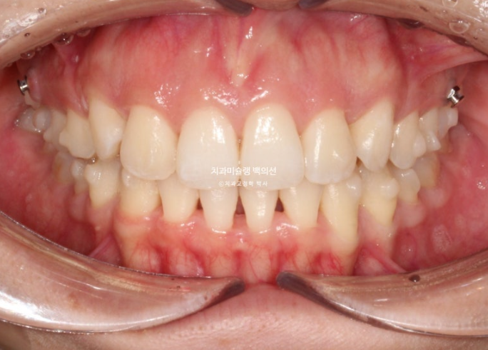 비발치 인비절라인 교정 돌출입 교정 후기 관련 이미지 7