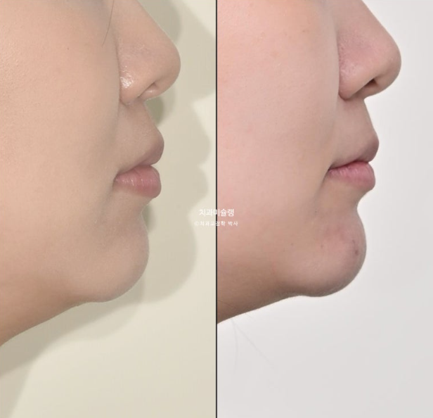 30대 인비절라인 덧니 발치교정 개방교합 치료 관련 이미지 26