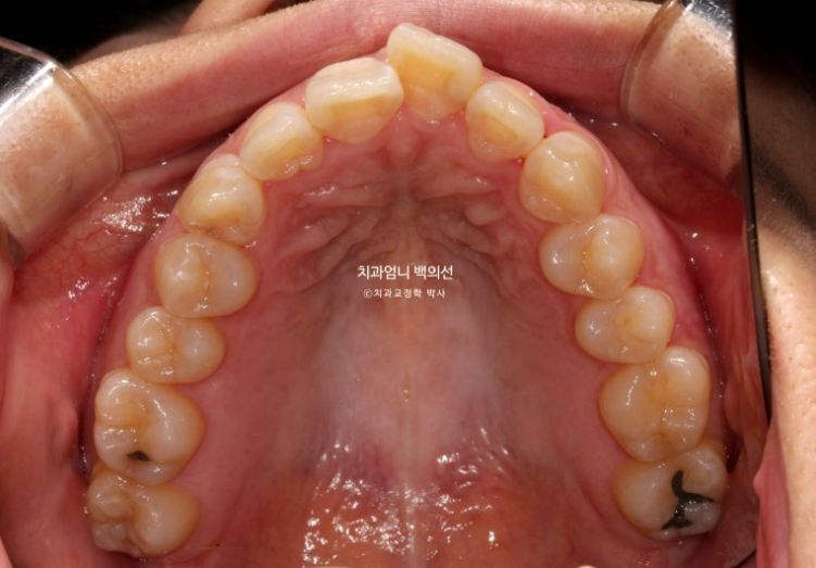 30대 교정 돌출입 교정 덧니 발치교정 치료기간 1년 8개월 관련 이미지 3