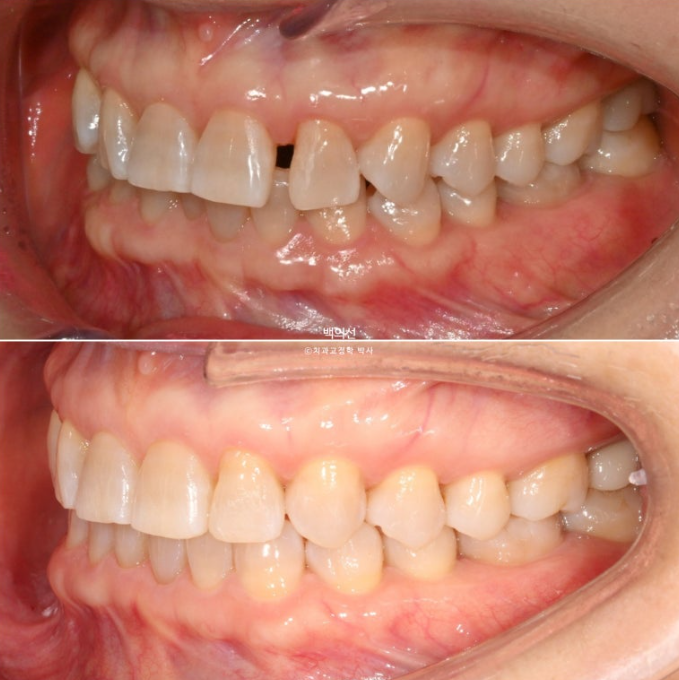 50대 치아교정 :: 인비절라인 익스프레스 치아 벌어짐 단기교정 후기 관련 이미지 16