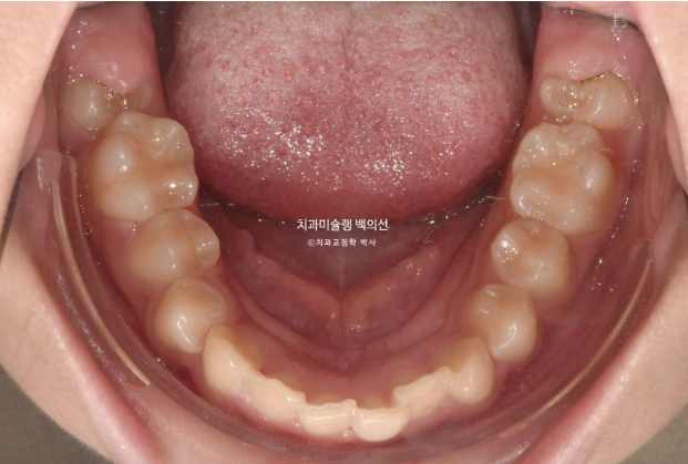 과개교합 인비절라인 모더레이트 컴프레헨시브 중심선 토끼이빨 관련 이미지 5