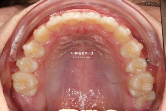 덧니 반대교합 과개교합 인비절라인 퍼스트 악궁확장 어린이 교정 치료 관련 이미지 12