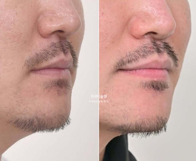 30대 MSE 악궁확장 덧니 반대교합 비발치 클리피씨 부작용 관련 이미지 20