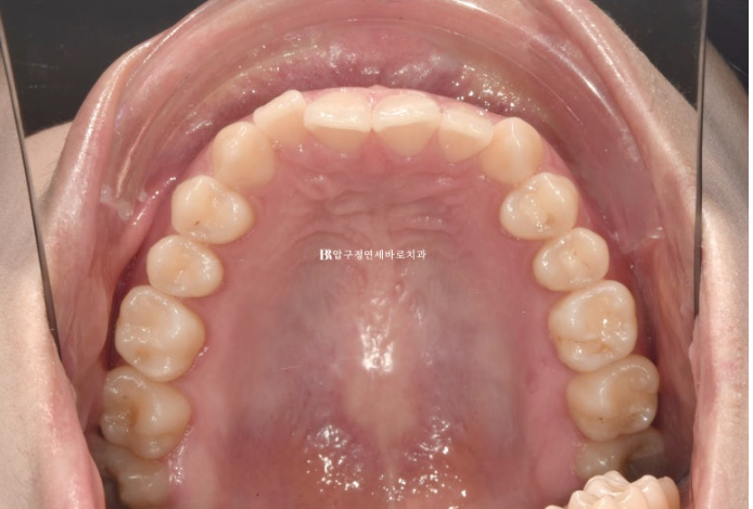 옥니 교정 인비절라인 라이트 옹니 덧니 치료기간 ? 관련 이미지 4