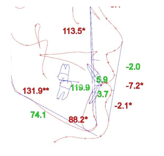 앞니 단기 부분교정 재교정 개방교합 교정 후기 관련 이미지 6