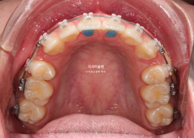 잇몸미소 거미스마일 치료 옥니 교정 잇몸성형 후기 관련 이미지 10