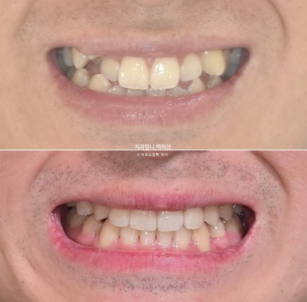 투명교정 인비절라인 덧니 교정 치료기간 알아보기 관련 이미지 15