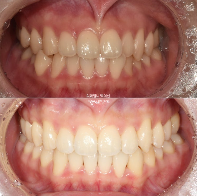 인비절라인 교정 비발치 비대칭 덧니 중심선 선천적 결손치 교정? 관련 이미지 18