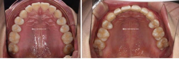 돌출입 교정 입동굴 클리피씨 교정 후기 관련 이미지 11