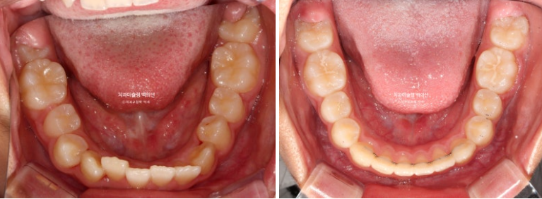 덧니 반대교합 과개교합 인비절라인 퍼스트 악궁확장 어린이 교정 치료 관련 이미지 21