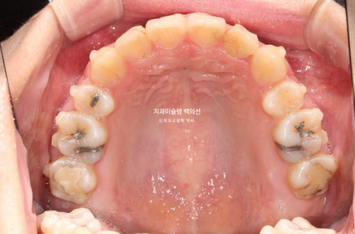 돌출입 인비절라인 발치교정 거미스마일 잇몸미소 잇몸돌출 입술부전증 무턱 재교정 관련 이미지 12