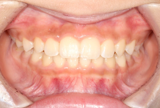 인비절라인퍼스트 어린이 투명교정 과개교합 덧니 악궁확장 돌출 관련 이미지 16