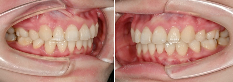 심한 돌출입 입술부전증 호두주름 발치교정 치료 관련 이미지 11