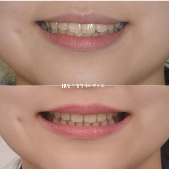 돌출입 교정 후 입매 변화, 과하지 않게 자연스럽게 관련 이미지 18