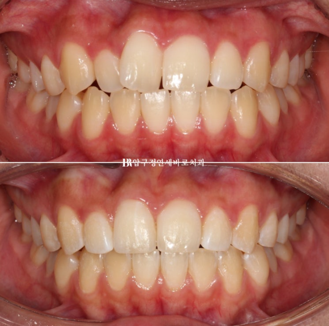 덧니교정 앞니부분교정 치간삭제 후기 관련 이미지 8