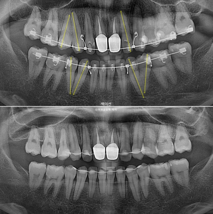 클리피씨 교정에서 인비절라인 변경 마무리 인비절라인 라이트 치료기간 4개월 관련 이미지 16