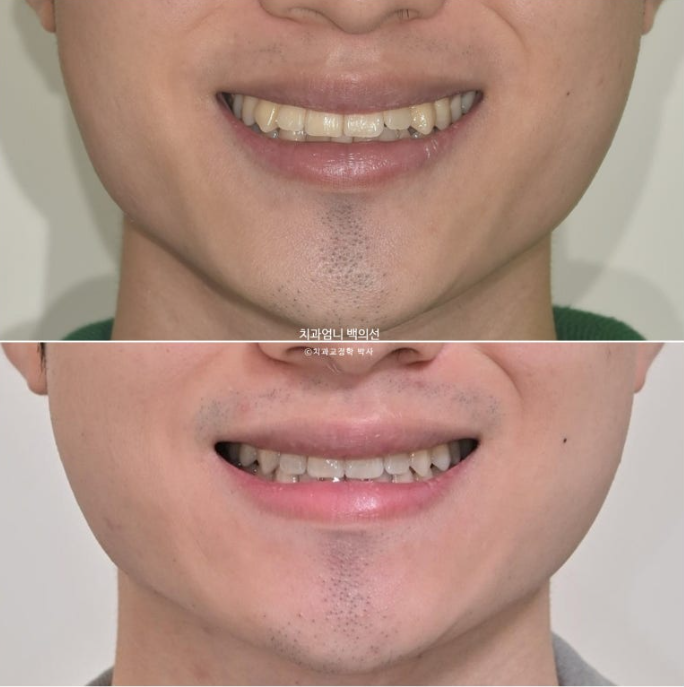 인비절라인 비발치 앞니 돌출 덧니 교정 ? 관련 이미지 17