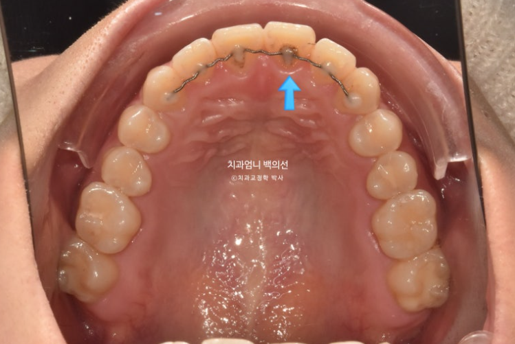 앞니 단기 부분교정 재교정 개방교합 교정 후기 관련 이미지 4