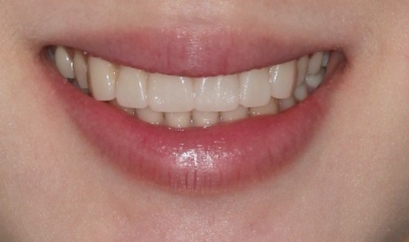 Before and After Non-Prep Veneers: Improving Gaps Between the Front Teeth and the Smile Line Together image 8