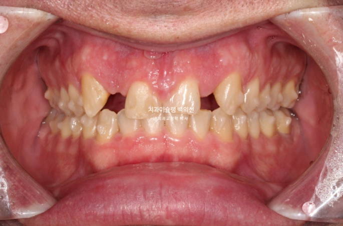 앞니 선천적 결손 인비절라인 임플란트 과개교합 치료 기간 관련 이미지 8