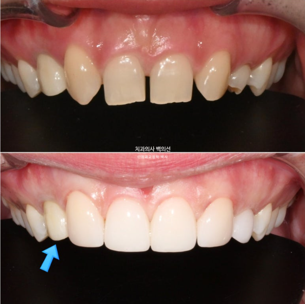 앞니 선천적 결손 벌어짐 잔존 유치 무삭제 라미네이트 관련 이미지 9