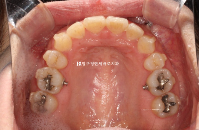 Does Invisalign Prevent Root Movement? Before-and-After Comparison of Extraction Treatment for Protruding Lips image 7