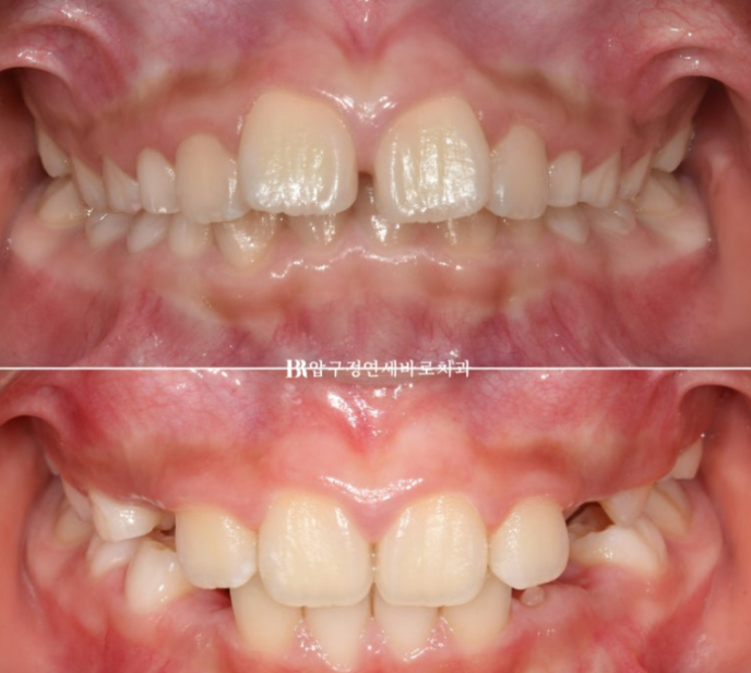 무턱교정 어린이 투명교정 인비절라인 퍼스트 교정 후기 관련 이미지 1