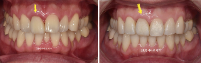 안보이는 앞니 교정 2D 교정 부분교정 후기 / 교정 시 잇몸이 더 나빠지지 않을까요? 관련 이미지 5