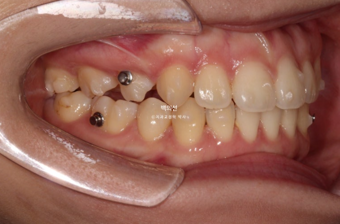 돌출입 교정 인비절라인 발치 교정 개방교합 치료 후기 관련 이미지 11