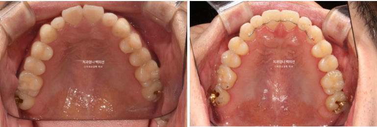 주걱턱 교정 반대교합 소구치 선천적 결손 부정교합 비발치 교정 후기 관련 이미지 12