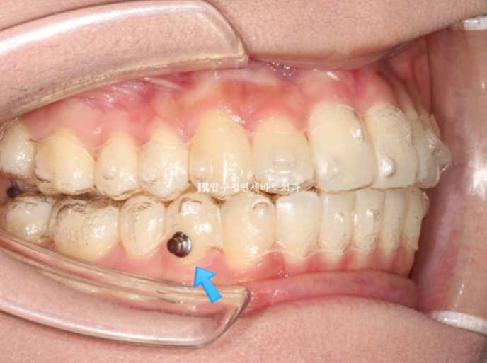 Invisalign Lite Treatment for Crossbite, Rabbit Teeth, and Protruding Front Teeth Correction image 5