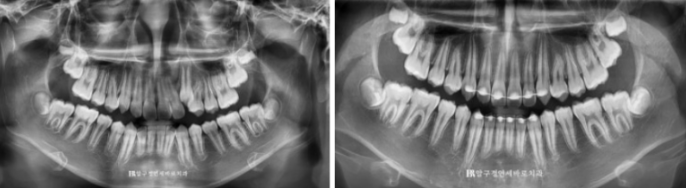 덧니 인비절라인 교정 :: 강남 인비절라인 교정치과 관련 이미지 9