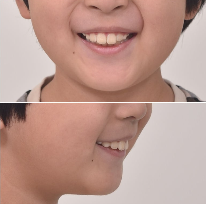 어린이 돌출입 교정 무턱 투명교정 인비절라인 퍼스트 관련 이미지 5