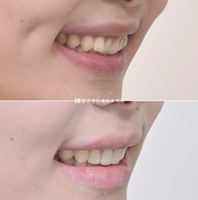 압구정 교정치과 / 옥니교정 인비절라인 라이트 덧니교정 관련 이미지 17