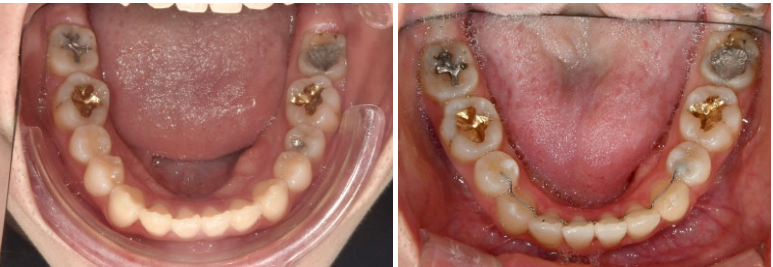 돌출입 인비절라인 발치교정 거미스마일 잇몸미소 잇몸돌출 입술부전증 무턱 재교정 관련 이미지 17