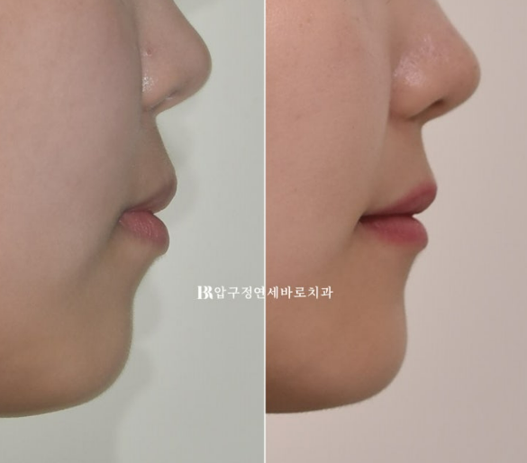 돌출입 교정 후 입매 변화, 과하지 않게 자연스럽게 관련 이미지 15