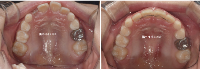 A Real Case of Preventing Crowded Teeth with Invisalign First for a Child in Gangnam image 6