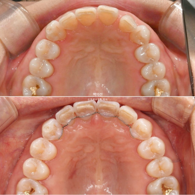 50대 치아교정 :: 인비절라인 익스프레스 치아 벌어짐 단기교정 후기 관련 이미지 17