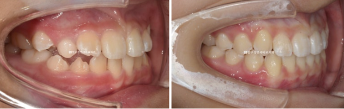 Simultaneous Arch Expansion and Teeth Alignment for Elementary School Children with Invisalign｜Invisalign First image 12