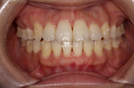 30대 돌출입 덧니 교정 인비절라인 발치교정 후기 관련 이미지 9