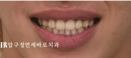 압구정 인비절라인 라이트 과개교합 후기 관련 이미지 7