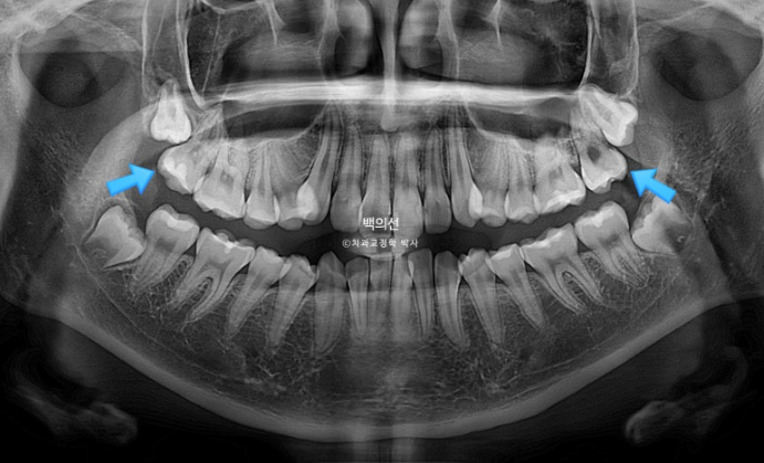 비발치 덧니교정 인비절라인 교정 사랑니 이용 교정 관련 이미지 6