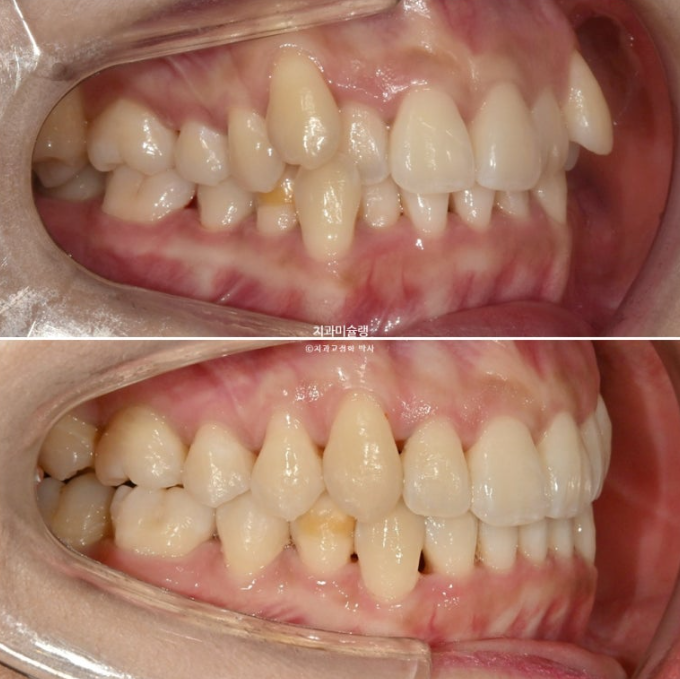 인비절라인 비발치 제2대구치 발치 사랑니 대체 교정 심한 덧니 교정 치료 관련 이미지 22