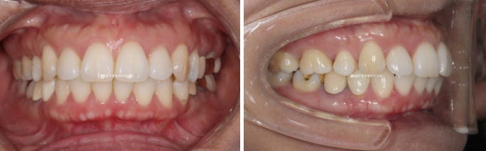 40대 재교정 가능할까요? 비발치 돌출입 교정 호두턱 팔자주름 후기 관련 이미지 1