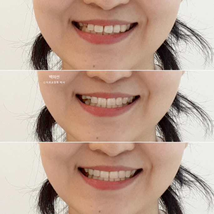 매복 결손 잔존유치 라미네이트 크라운 캔팅 인비절라인 라이트 치료 관련 이미지 8