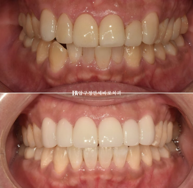 40대 치아교정 인비절라인 라이트 덧니 교정 어금니 교합 부작용 관련 이미지 1