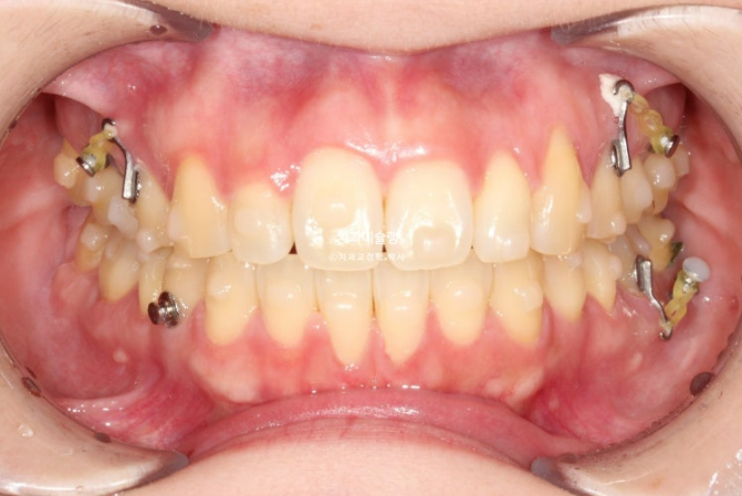 비발치 인비절라인 교정 편측 개방교합 가위교합 돌출 재교정 관련 이미지 12