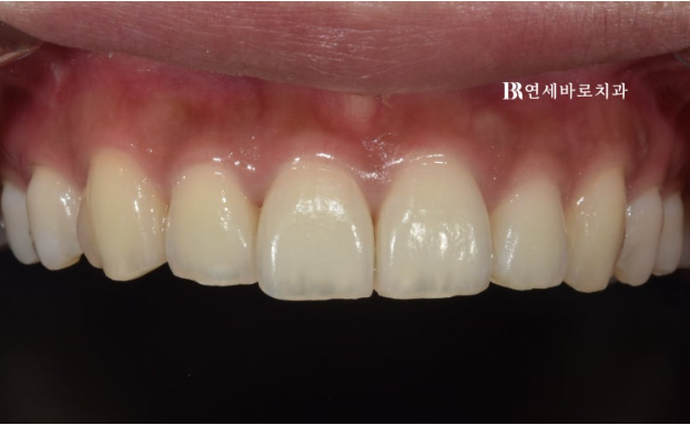 무삭제 라미네이트 젤라미 정말 최소삭제도 안할까? 관련 이미지 1